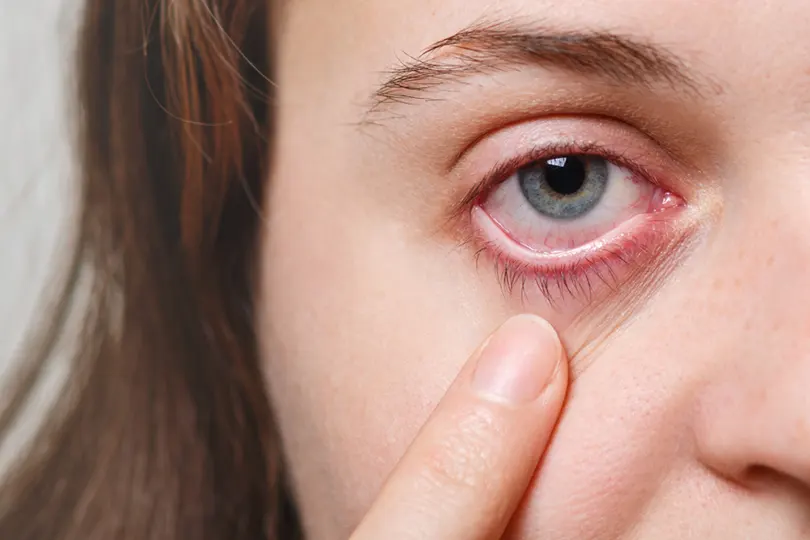 Conjunctivitis care : Eye Flu से जल्दी ठीक होने के लिए आंखों की देखभाल के टिप्स